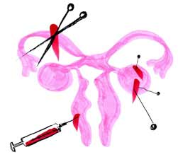 Illustration av livmoder med nålar i